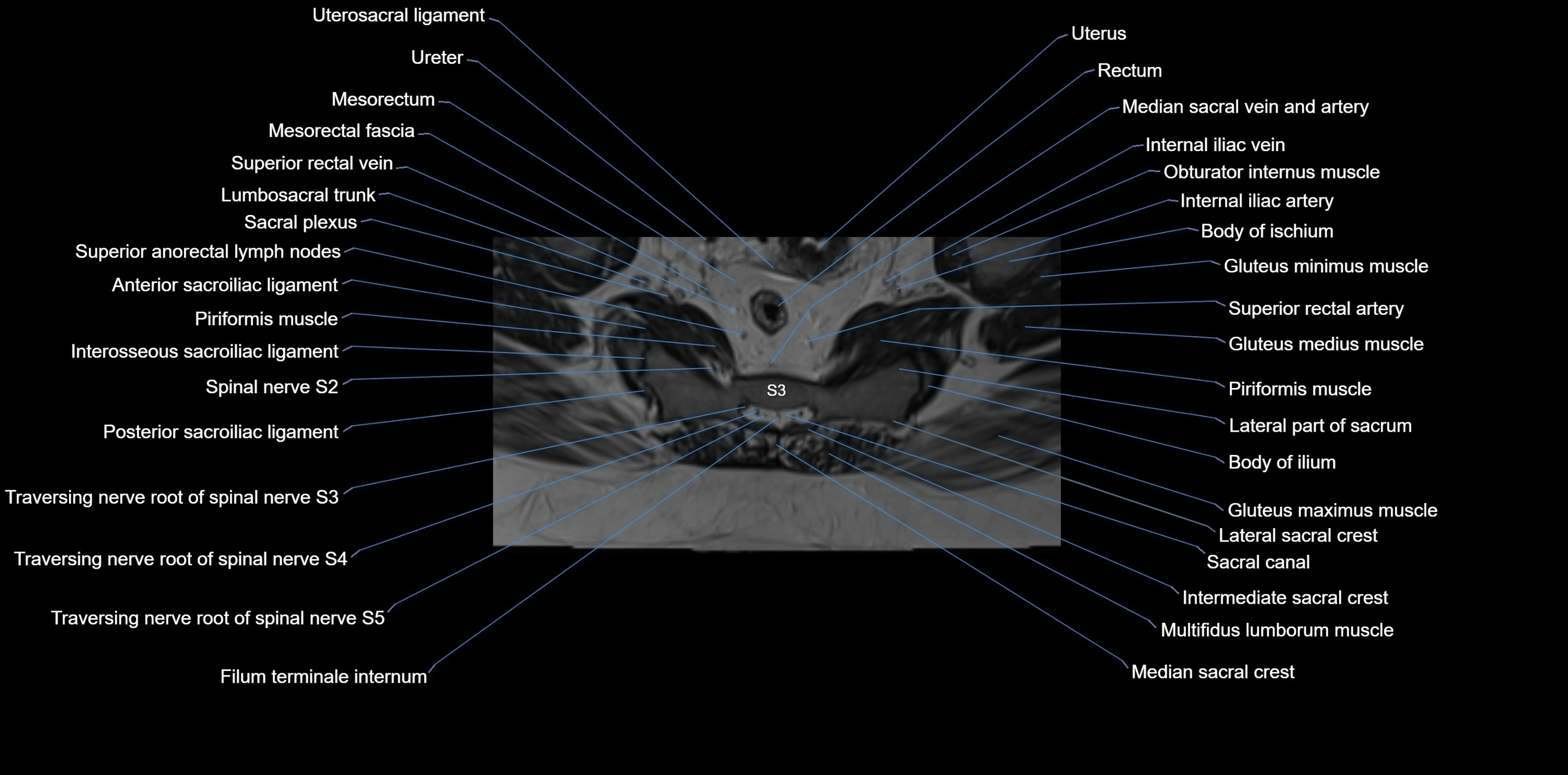 MRI sacrum, coccyx and sacroiliac joint axial cross sectional anatomy 3T  radiology  image-img-00001-00037.webp